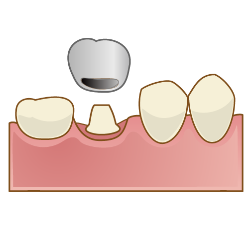 詰め物、銀歯が取れた方