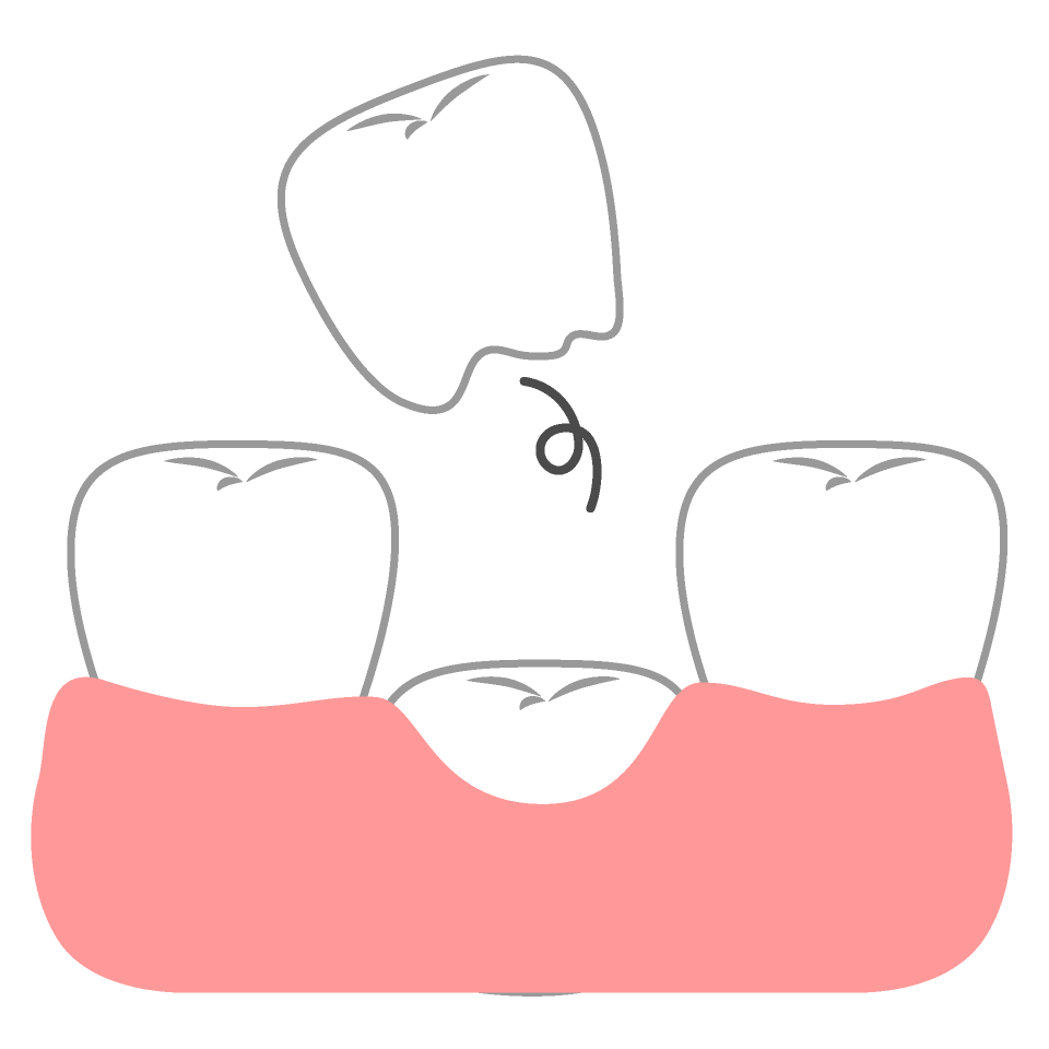 抜けそうな歯がある（乳歯・永久歯）
