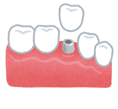 インプラント相談