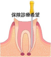 顕微鏡での歯の根の治療の相談　保険治療希望