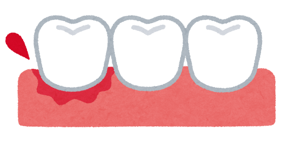 歯ぐきから血が出る