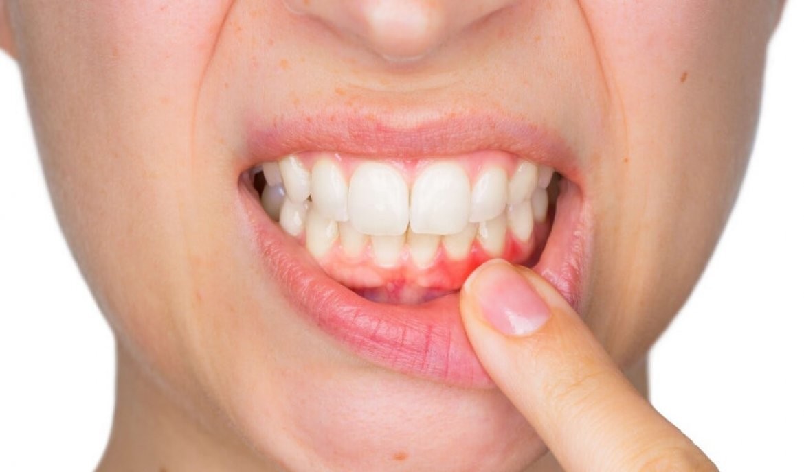 歯周病治療・再生療法